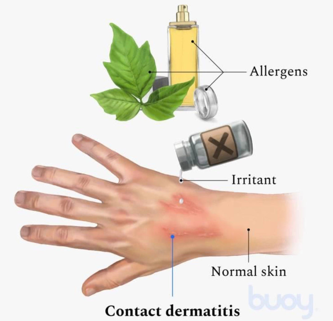 Contact Dermatitis: When the Skin Meets an Irritant or Allergen