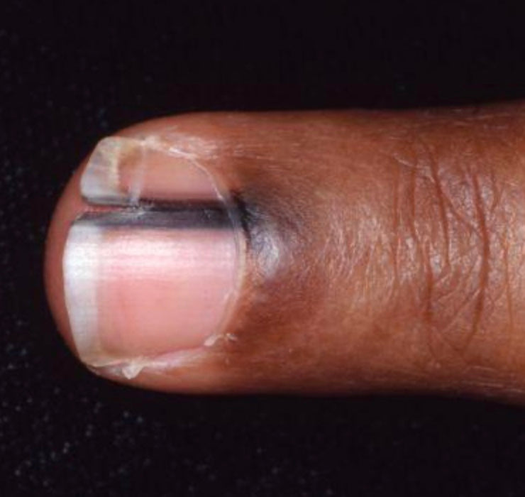 The Visual Signs of Skin Cancer: Melanoma